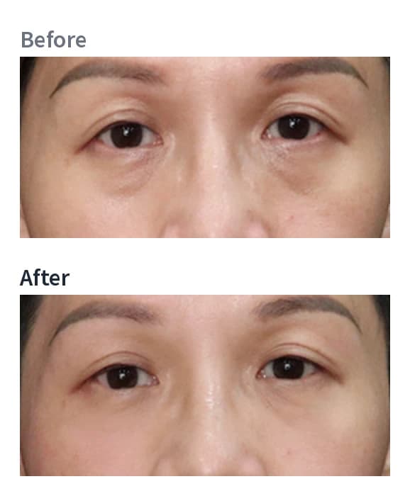 Eye area — BTL EXION Face