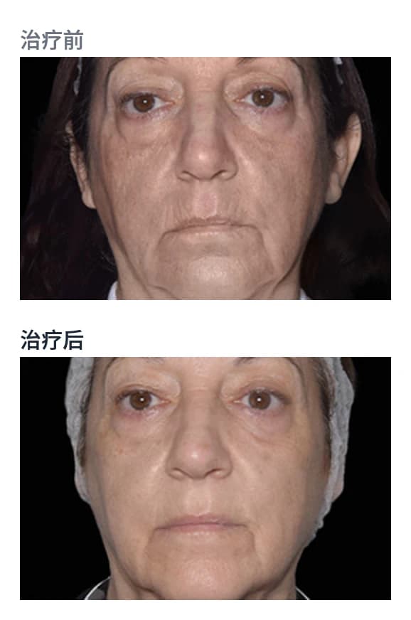 面部 — BTL EXION Face