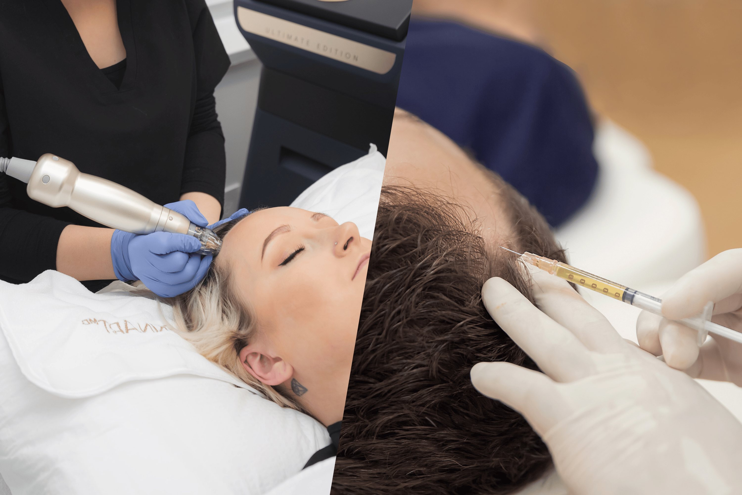 Exosomes vs. PRP Plus: The 2026 Guide to Non-Surgical Hair Restoration