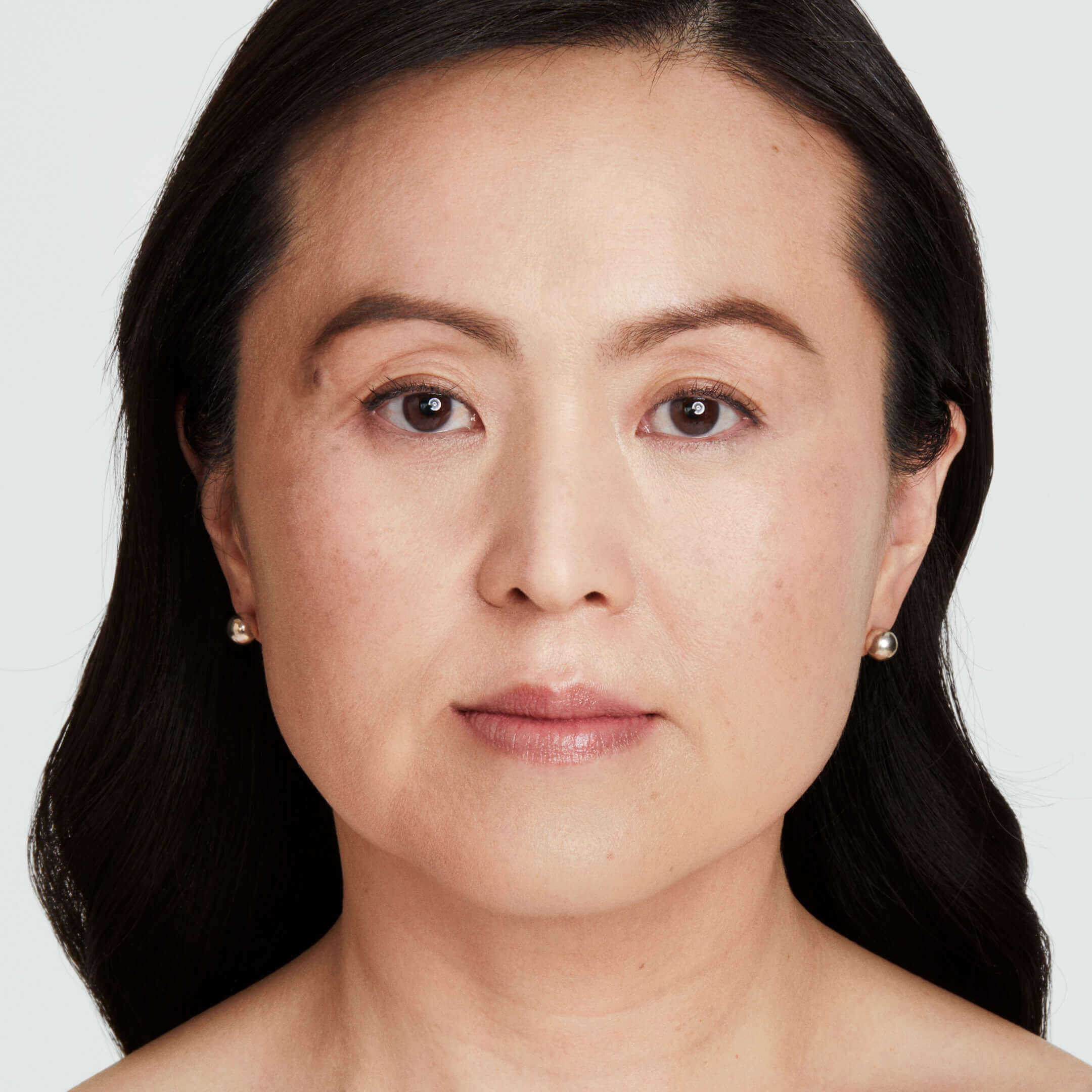 Ultherapy Before Result