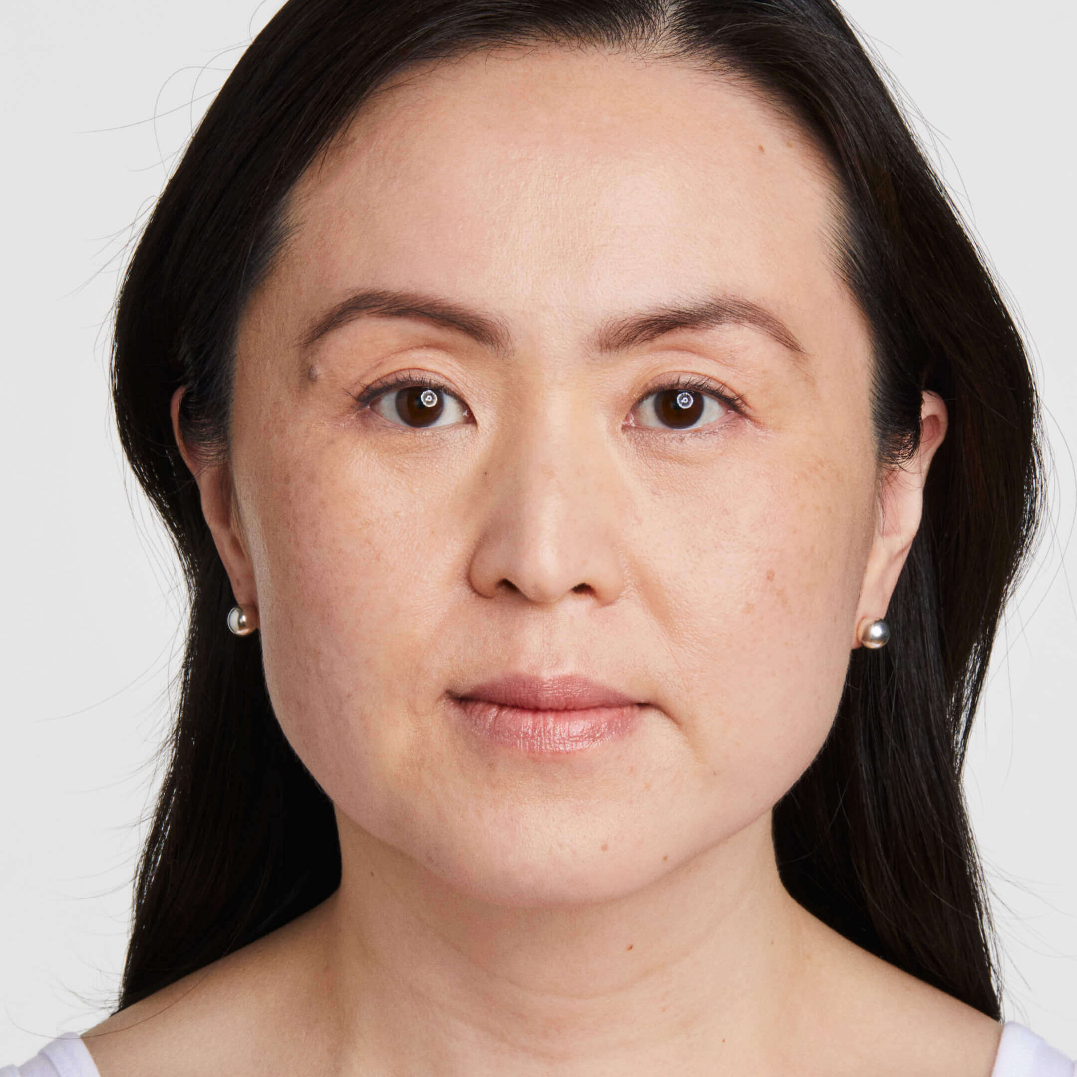 Ultherapy After Result